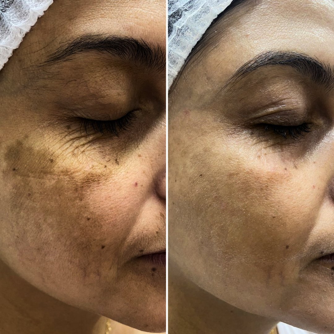 Resultado de tratamento 3