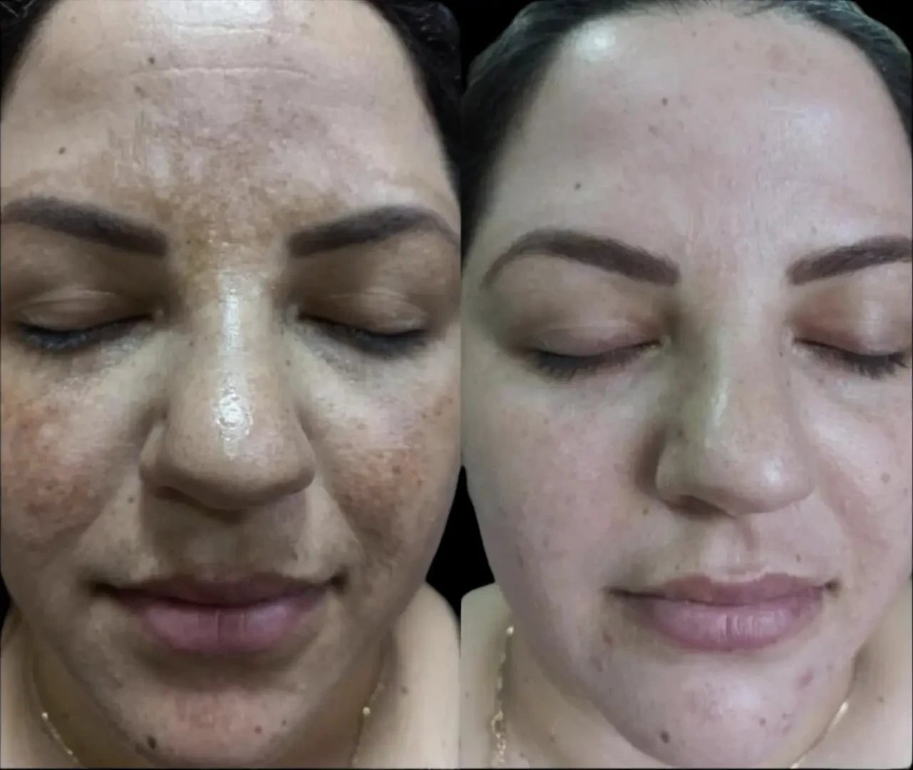 Resultado de tratamento 6