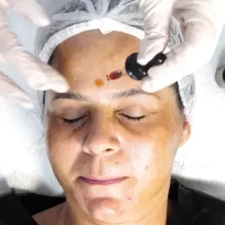 Peelings Estratégicos